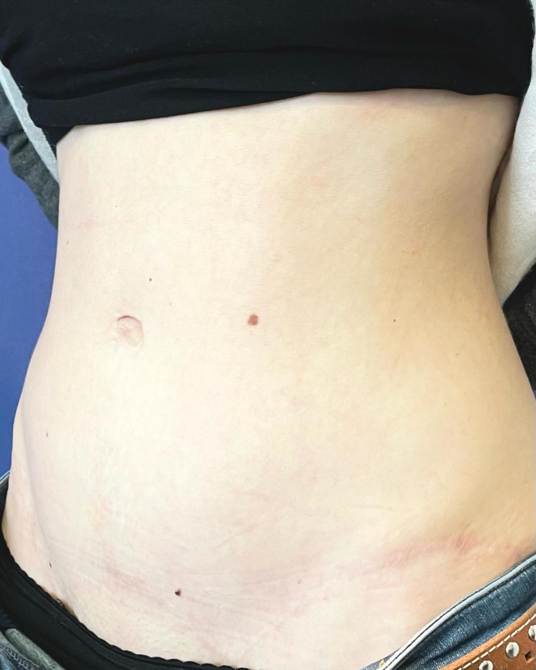 Bilder nach Bauchstraffung nach Schwangerschaften